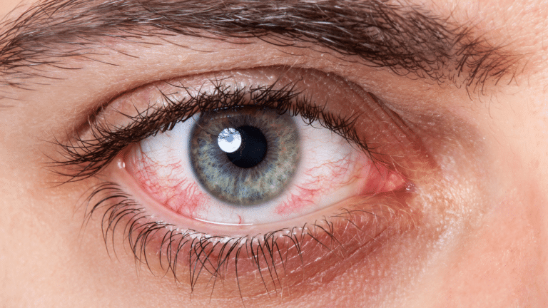 Veroorzaakt het gebruik van cannabidiol rode ogen?